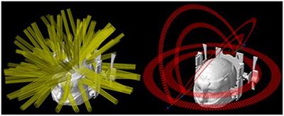 Frameless Image-Guided Radiosurgery for Multiple Brain Metastasis Using VMAT: A Review and an Institutional Experience